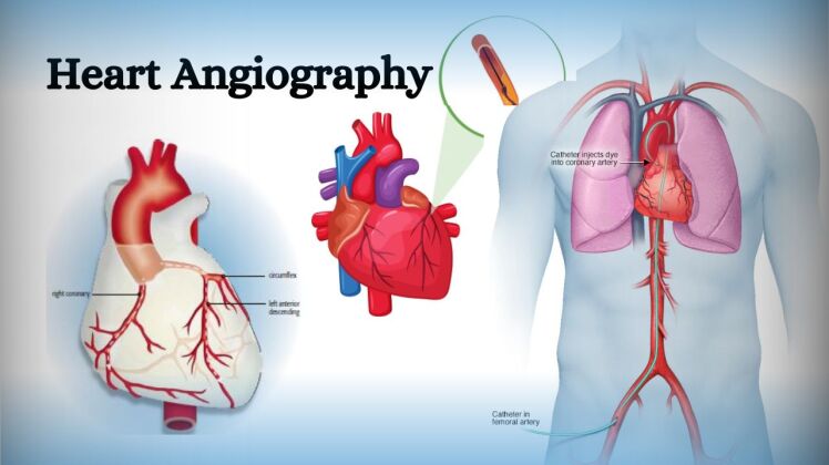 Angioplasty Scientific study of cardiovascular interventions