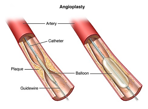 ?What is Angiography